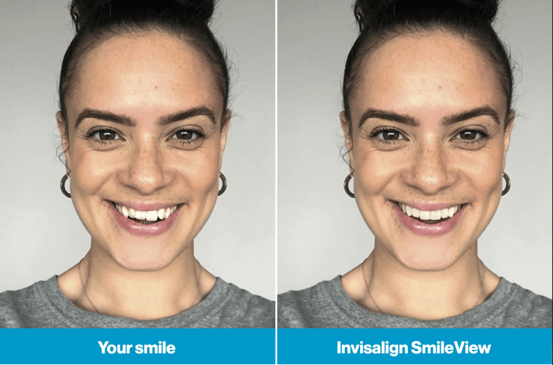 Invisalign smile